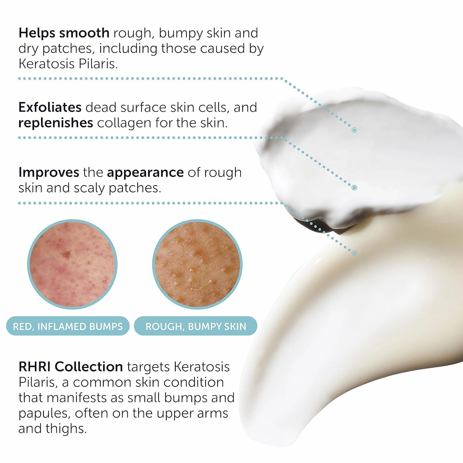 KP Bump Eraser Body Set | Keratosis Pilaris Treatment | Keratosis Pilaris Lotion | Exfoliating Body Scrub | Ingrown Hair Treatment | Bundle Set for Bump, Strawberry Legs, Redness, Dry & Flakey Skin